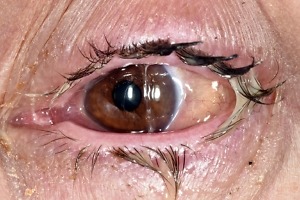 Symptoms of Bacteria conjunctivitis