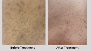 before and after chemical peel treatment on the back
